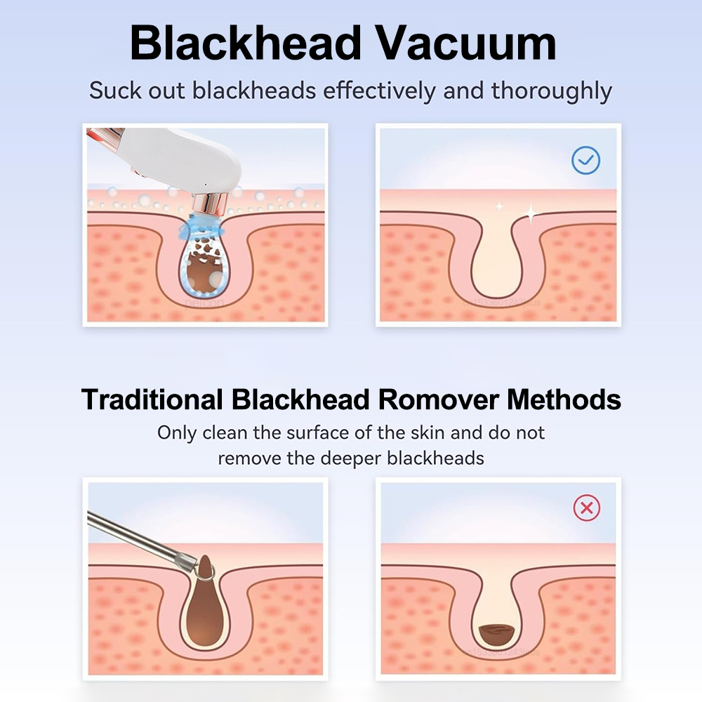 Electric Blackhead Remover Vac - Pore Vacuum ulasan dan harga