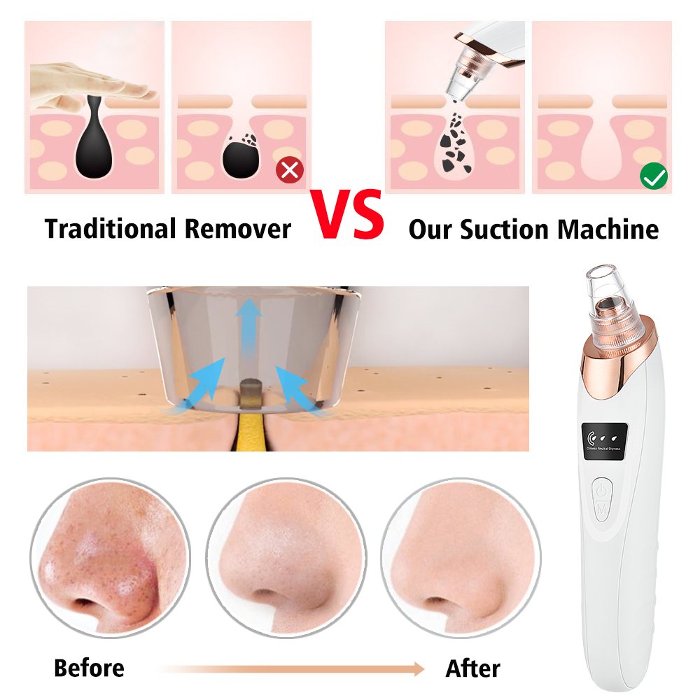 Blackhead Remover Vacuum Pore  - Pore Vacuum ulasan dan harga